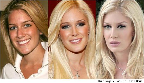 Nicki Minaj Before And After Plastic Surgery Pictures. heidi montag efore and after
